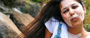 El por que del Vitiligo