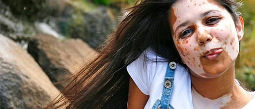 El por que del Vitiligo